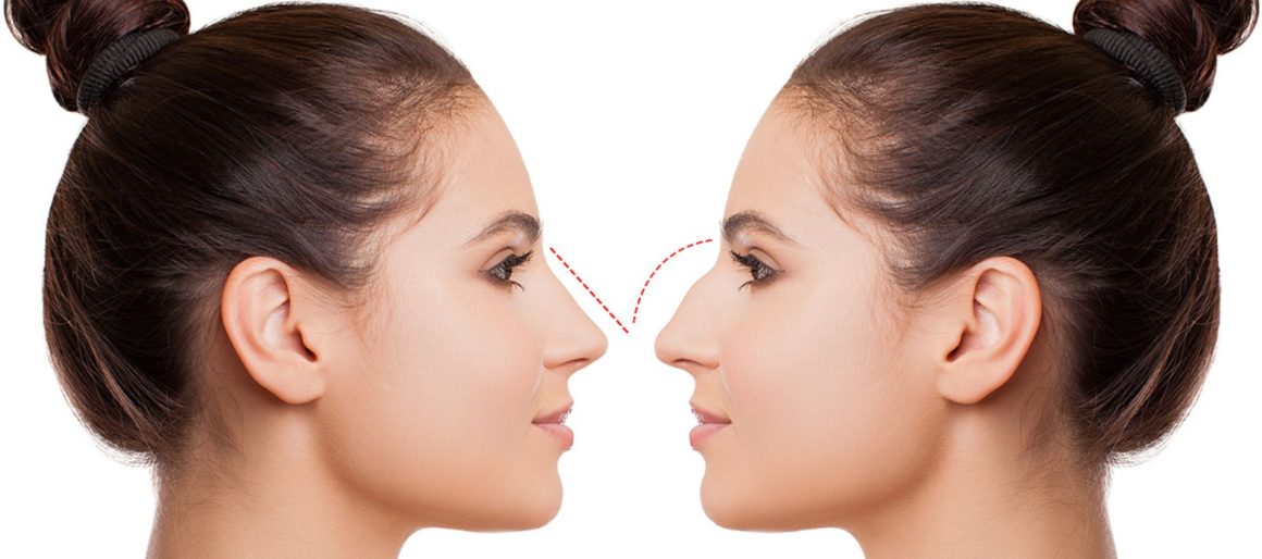 Estetica e Sorriso "Rinoplastica in Albania"