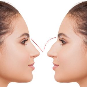 Estetica e Sorriso "Rinoplastica in Albania"