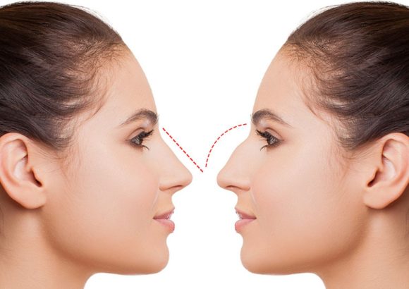 Estetica e Sorriso "Rinoplastica in Albania"