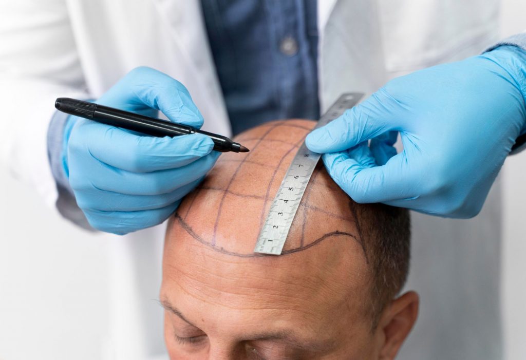 Trapianto di Capelli