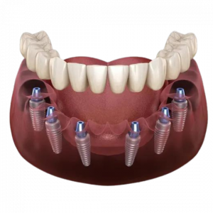Cure Dentali in Albania