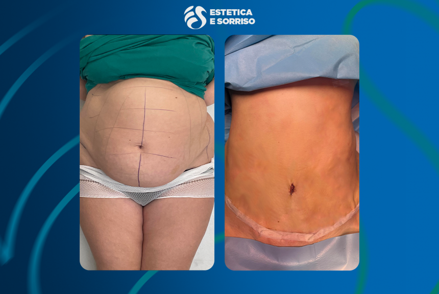 Addominoplastica in Albania - Estetica e Sorriso