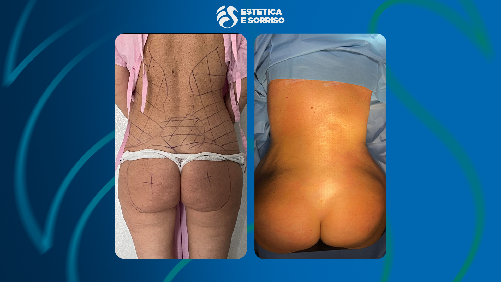 Liposcultura - Estetica e Sorriso