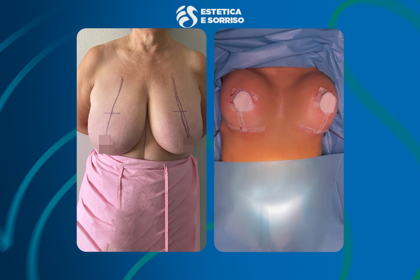 Mastoplastica riddutiva - Estetica e Sorriso