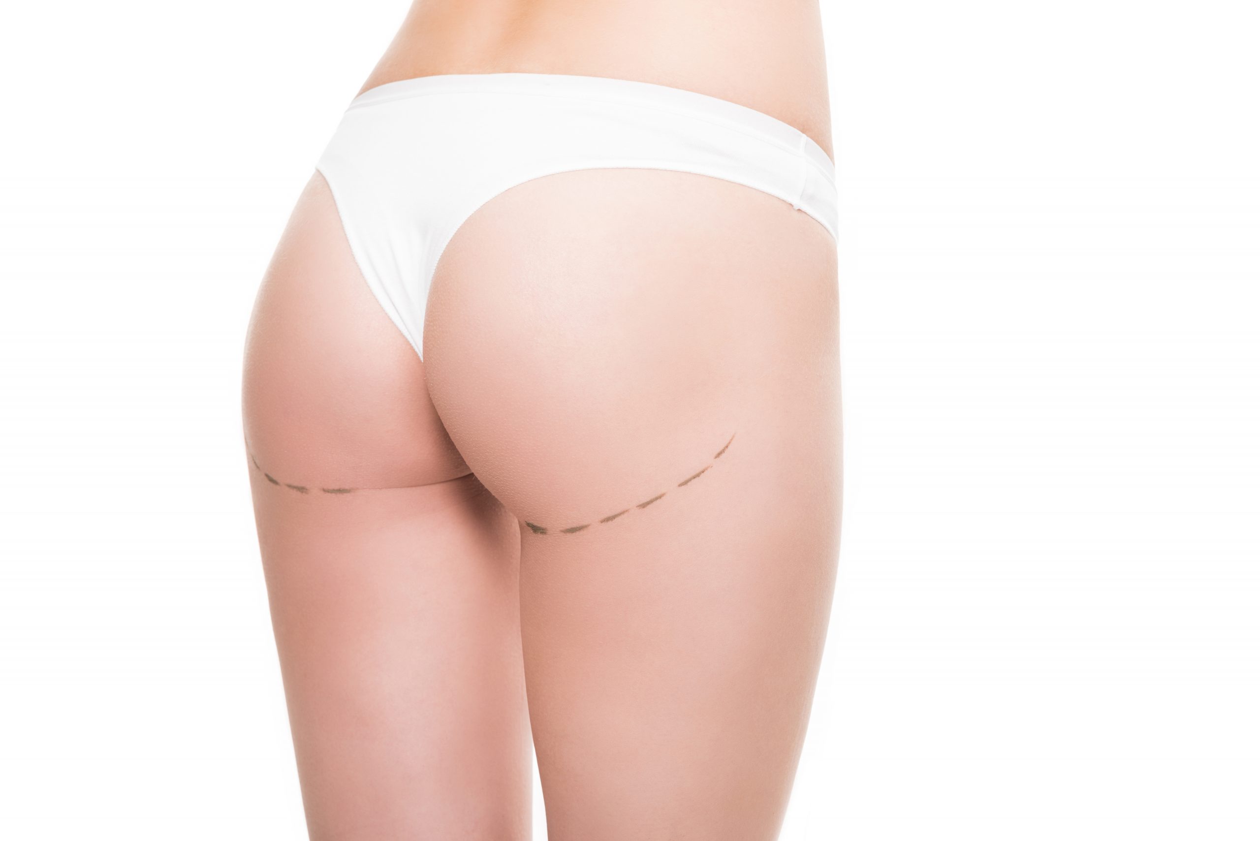 Estetica e Sorriso "Brazilian Butt Lift in Albania"