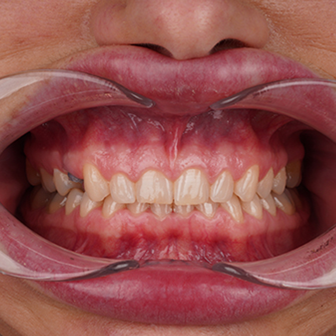 Estetica e Sorriso "Faccette eMax in Albania"