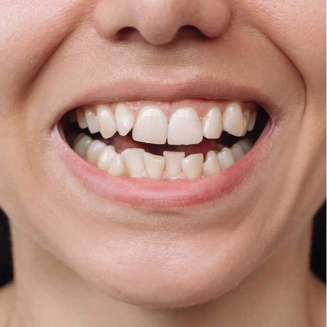 Estetica e Sorriso "Mascherine Invisalign in Albania"