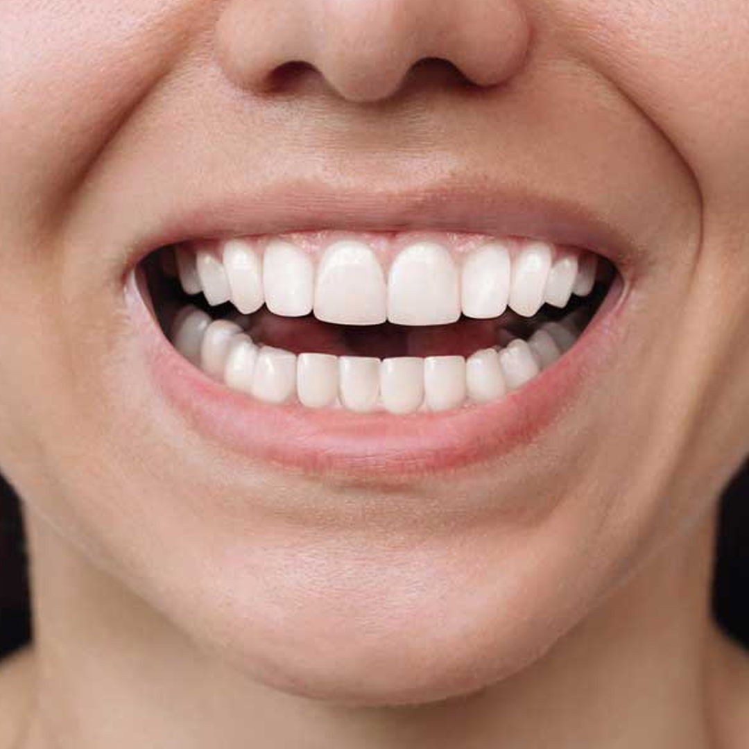Estetica e Sorriso "Mascherine Invisalign in Albania"