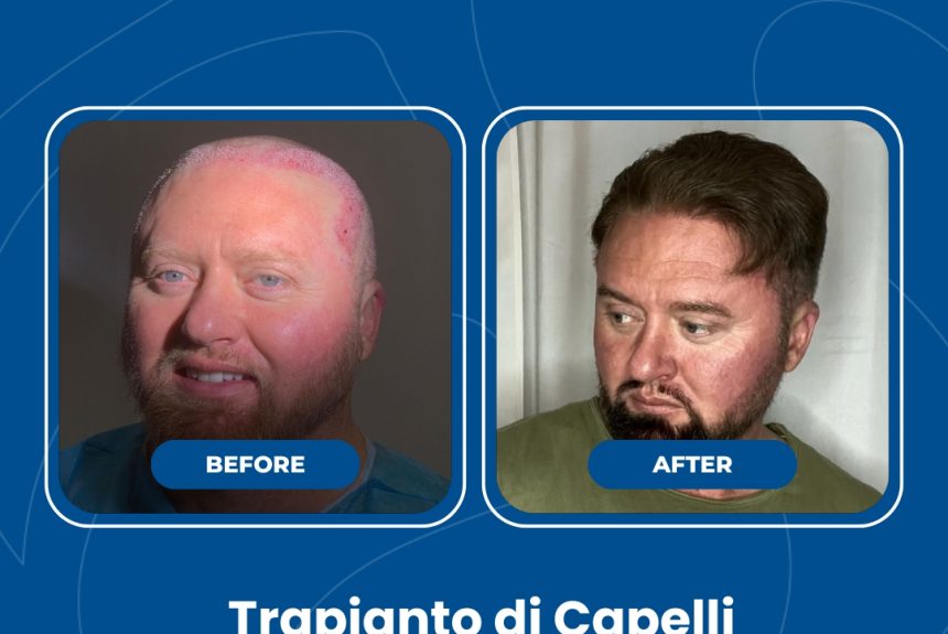 Trapianto di capelli - Estetica e Sorriso - Estetica e Sorriso Trapianto di capelli - Estetica e Sorriso