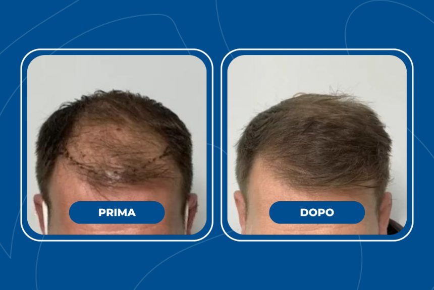 Trapianto di capelli - Estetica e Sorriso