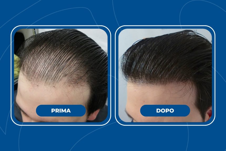 Trapianto di capelli - Estetica e Sorriso