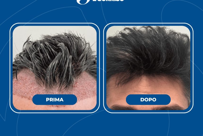 Trapianto di capelli - Estetica e Sorriso