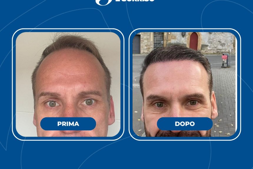 Trapianto di capelli - Estetica e Sorriso - Estetica e Sorriso Trapianto di capelli - Estetica e Sorriso