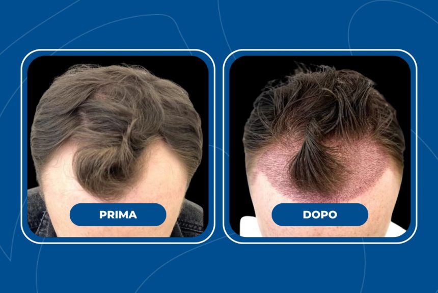Trapianto di capelli - Estetica e Sorriso - Estetica e Sorriso Trapianto di capelli - Estetica e Sorriso