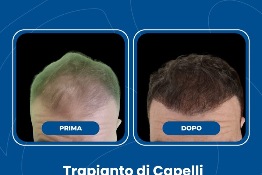 Trapianto di capelli - Estetica e Sorriso - Estetica e Sorriso Trapianto di capelli - Estetica e Sorriso