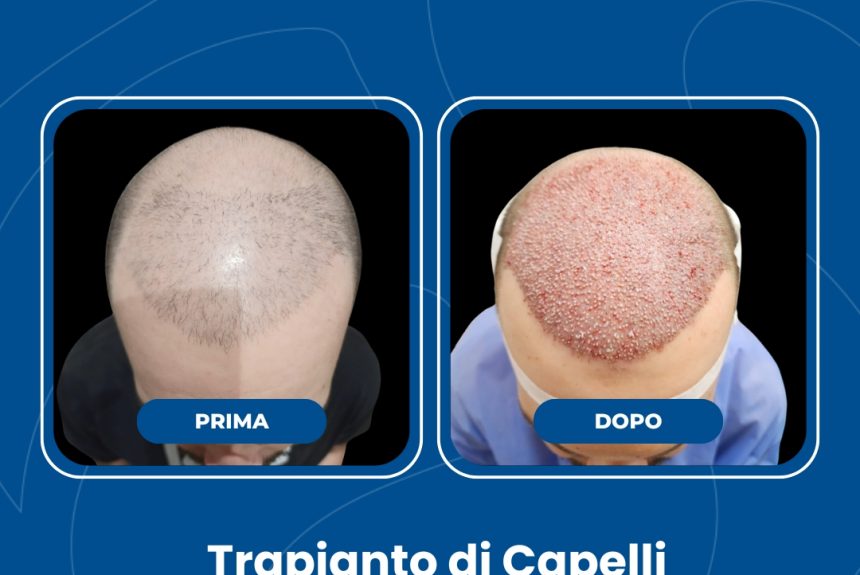 Trapianto di capelli - Estetica e Sorriso - Estetica e Sorriso Trapianto di capelli - Estetica e Sorriso