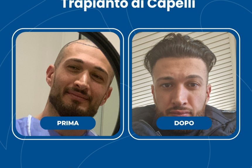 Trapianto di capelli - Estetica e Sorriso - Estetica e Sorriso Trapianto di capelli - Estetica e Sorriso
