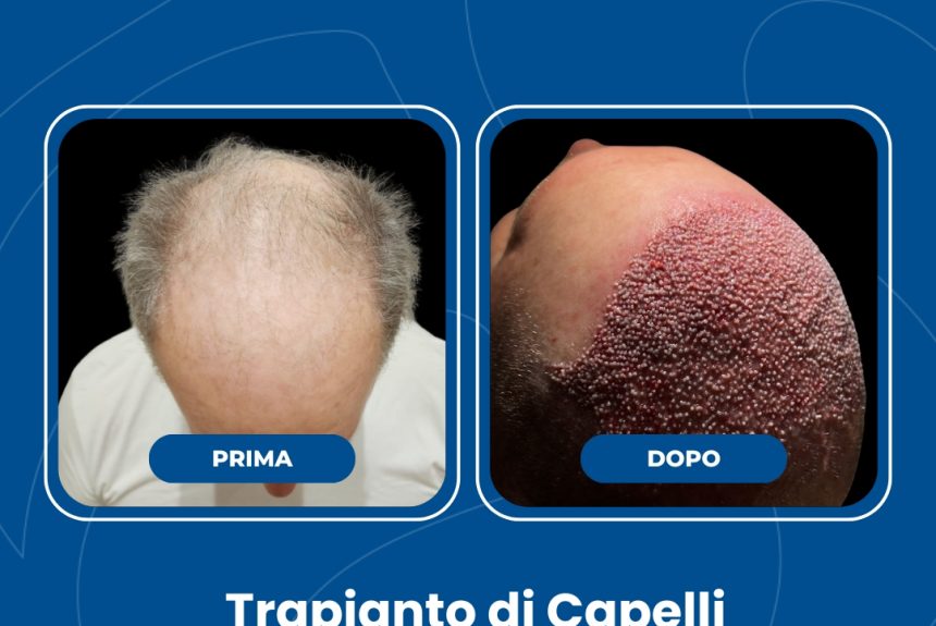 Trapianto di capelli - Estetica e Sorriso - Estetica e Sorriso Trapianto di capelli - Estetica e Sorriso