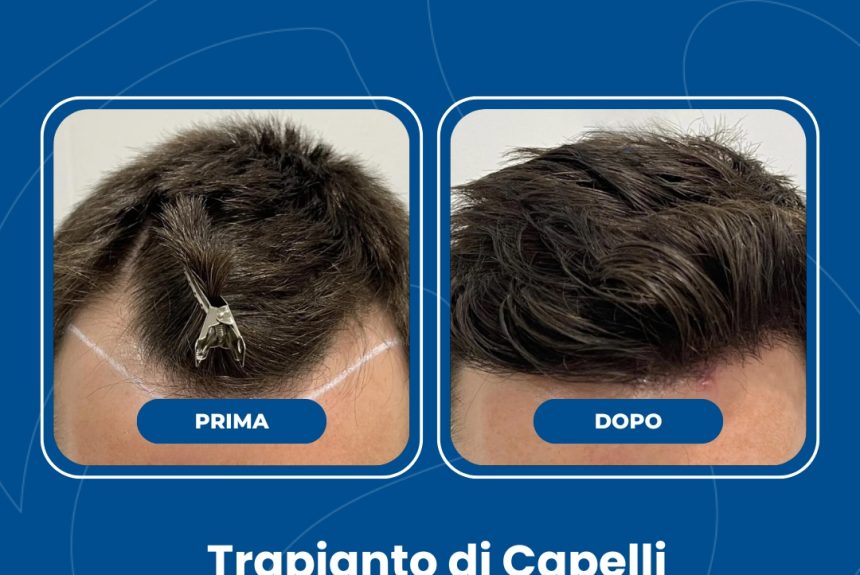 Trapianto di capelli - Estetica e Sorriso - Estetica e Sorriso Trapianto di capelli - Estetica e Sorriso