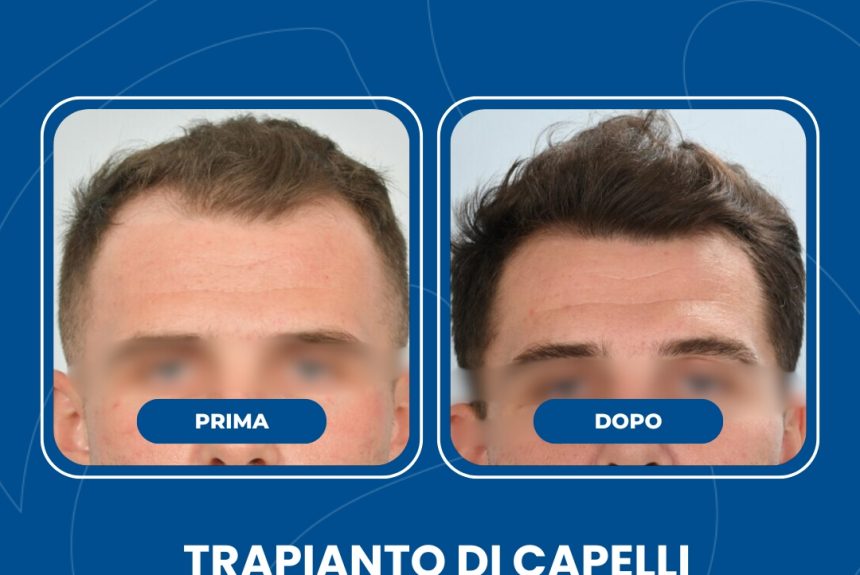 Trapianto di capelli - Estetica e Sorriso - Estetica e Sorriso Trapianto di capelli - Estetica e Sorriso