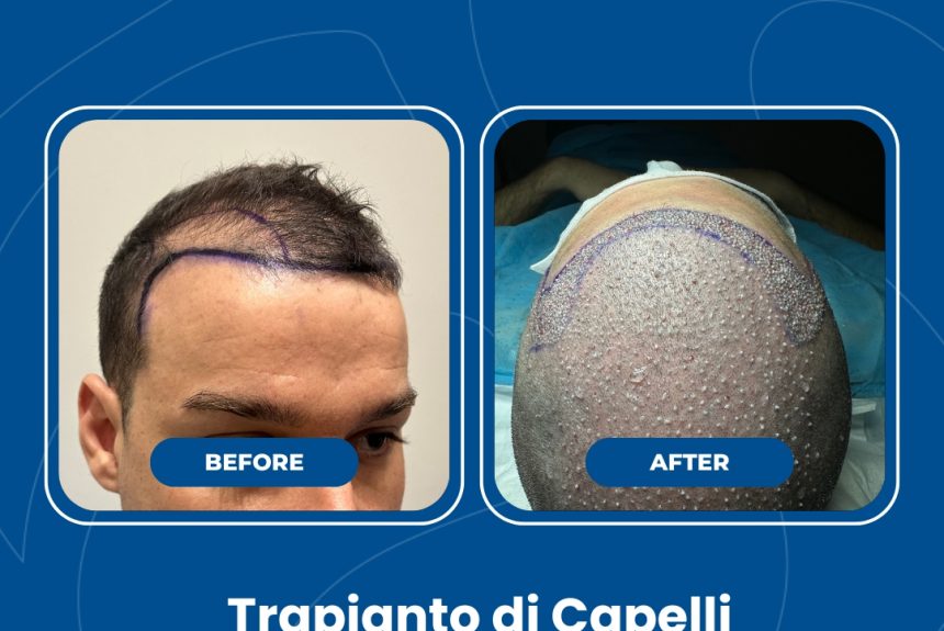 Trapianto di capelli - Estetica e Sorriso - Estetica e Sorriso Trapianto di capelli - Estetica e Sorriso