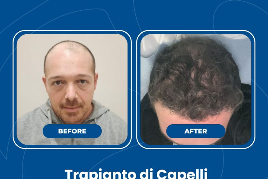 Trapianto di capelli - Estetica e Sorriso