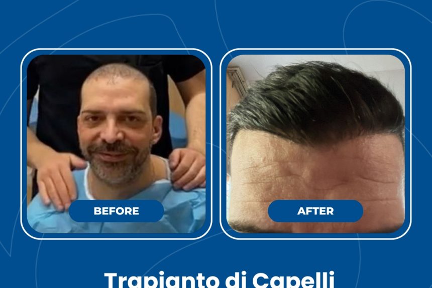 Trapianto di capelli - Estetica e Sorriso - Estetica e Sorriso Trapianto di capelli - Estetica e Sorriso