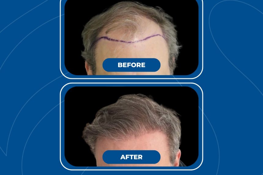 Trapianto di capelli - Estetica e Sorriso - Estetica e Sorriso Trapianto di capelli - Estetica e Sorriso