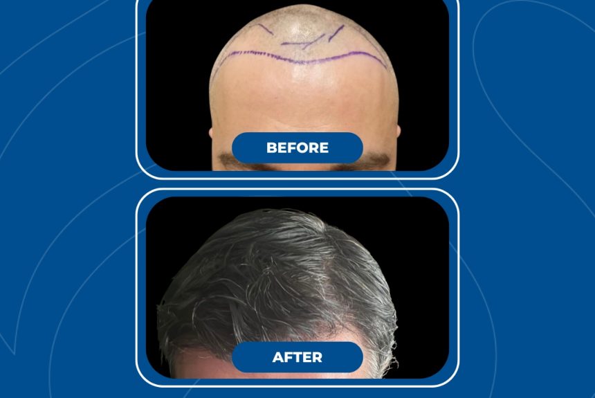 Trapianto di capelli - Estetica e Sorriso - Estetica e Sorriso Trapianto di capelli - Estetica e Sorriso