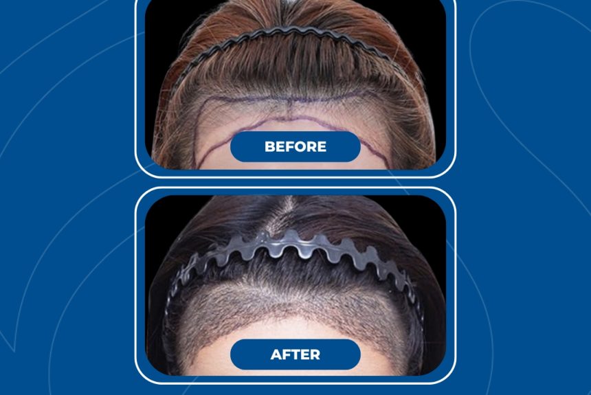 Trapianto di capelli - Estetica e Sorriso - Estetica e Sorriso Trapianto di capelli - Estetica e Sorriso