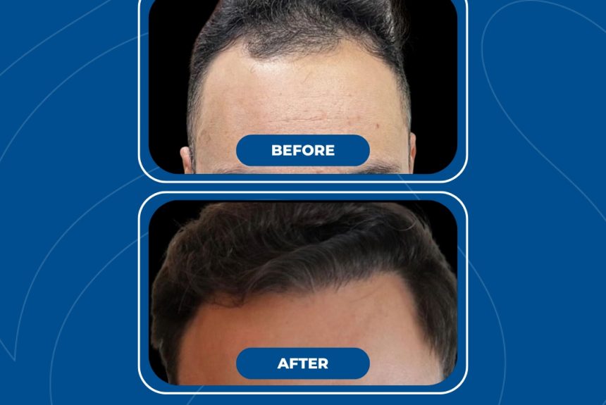 Trapianto di capelli - Estetica e Sorriso - Estetica e Sorriso Trapianto di capelli - Estetica e Sorriso