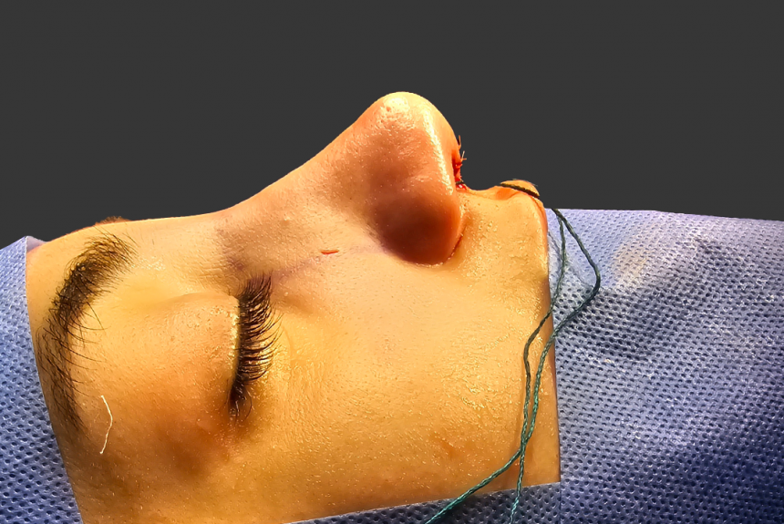 Estetica e Sorriso "Rinoplastica in Albania"