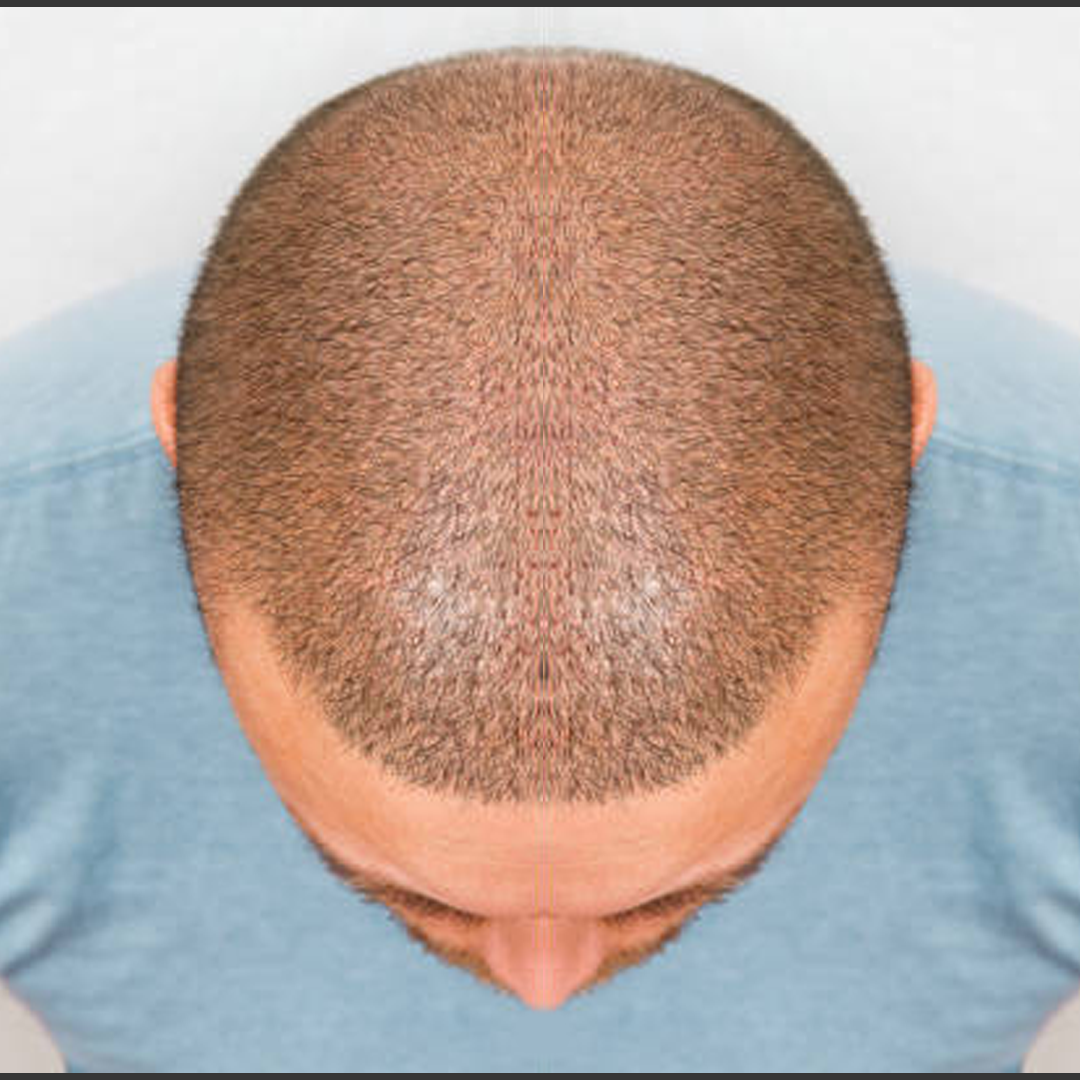 Estetica e Sorriso "Trapianto di Capelli in Albania"
