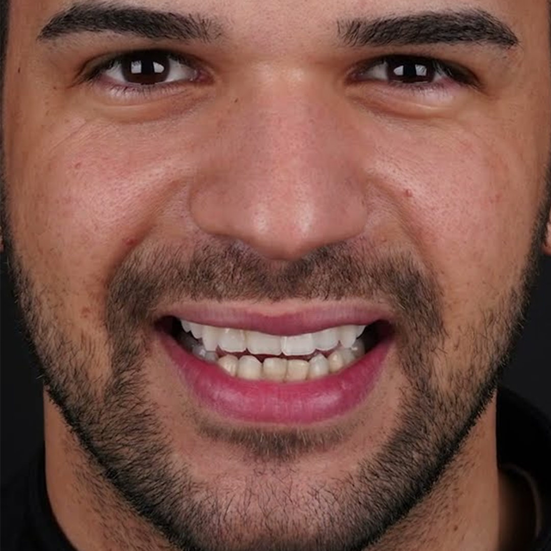 Estetica e Sorriso "Hollywood Smile in Albania"
