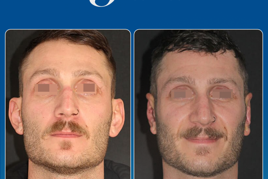 Estetica e Sorriso - Otoplastica (Gallery)