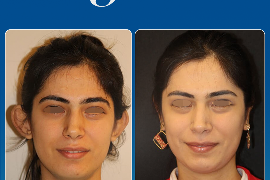 Estetica e Sorriso - Otoplastica (Gallery)