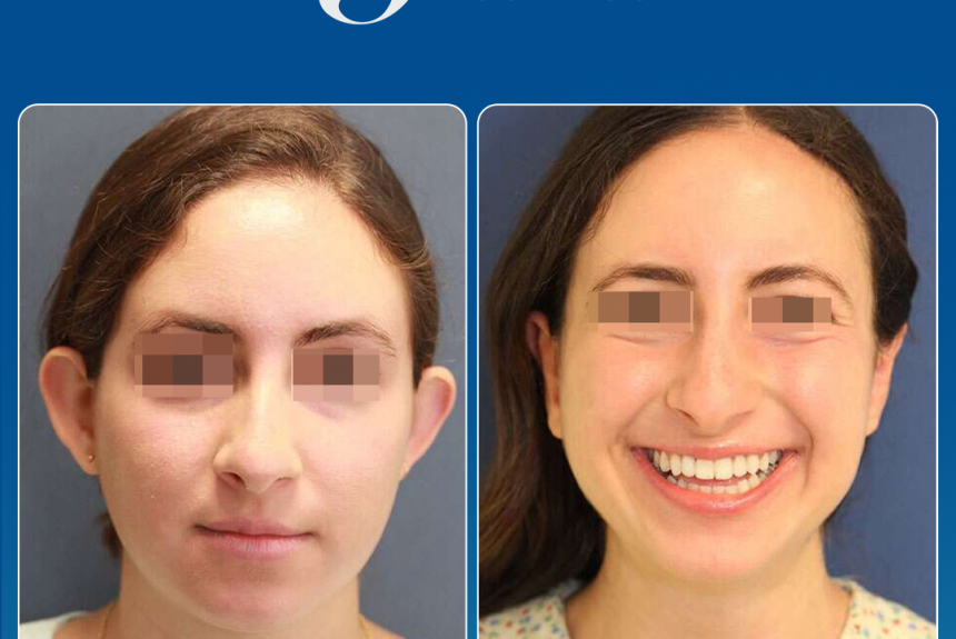 Estetica e Sorriso - Otoplastica (Gallery)