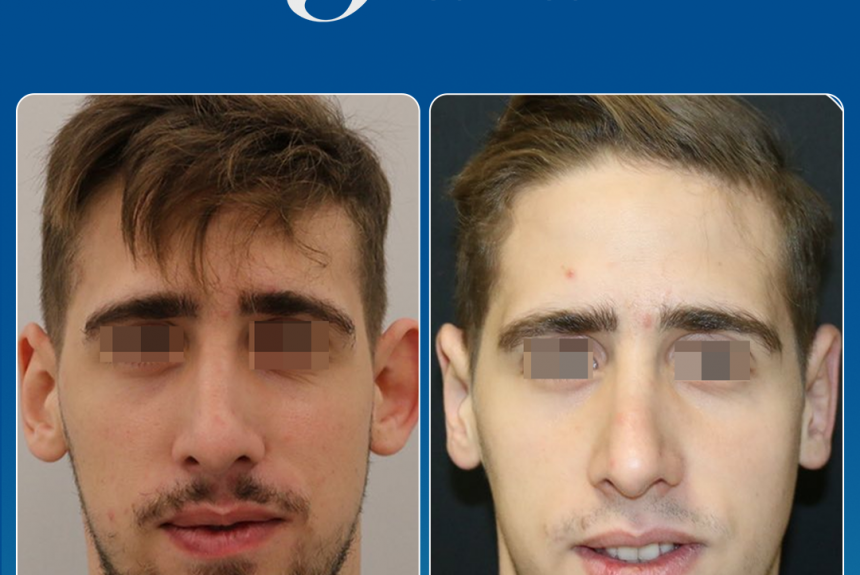 Estetica e Sorriso - Otoplastica (Gallery)