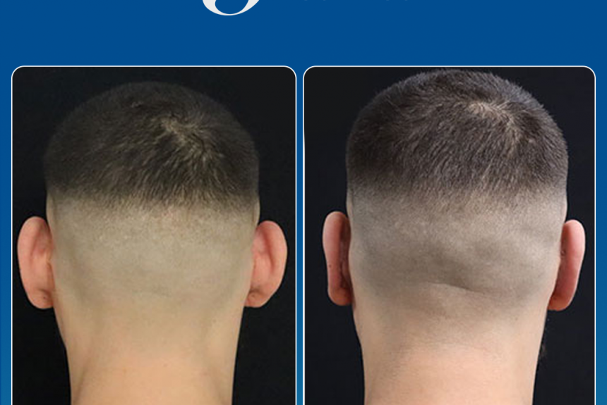 Estetica e Sorriso - Otoplastica (Gallery)