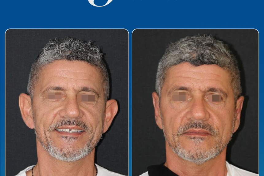 Estetica e Sorriso - Otoplastica (Gallery)