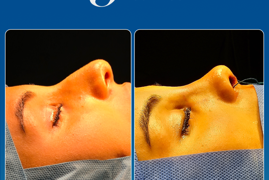 Rinoplastica in Albania - Estetica e Sorriso