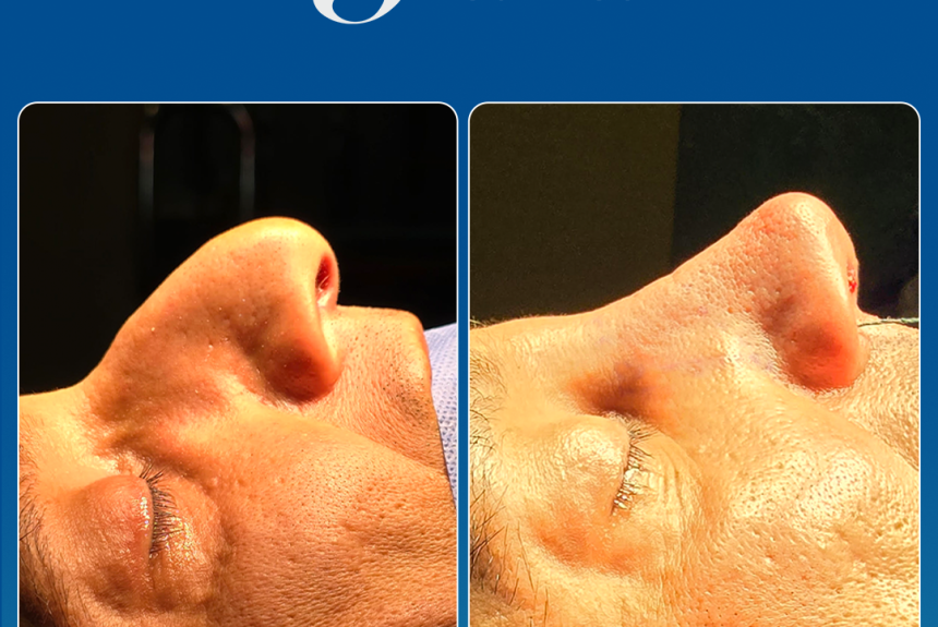 Rinoplastica in Albania - Estetica e Sorriso