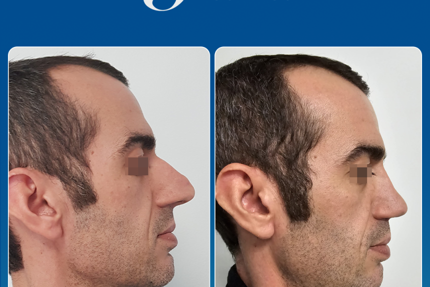 Rinoplastica in Albania - Estetica e Sorriso