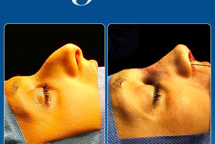 Rinoplastica in Albania - Estetica e Sorriso