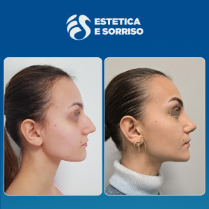 Rinoplastica in Albania - Estetica e Sorriso