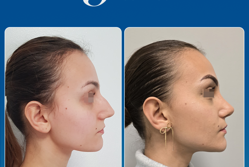 Rinoplastica in Albania - Estetica e Sorriso