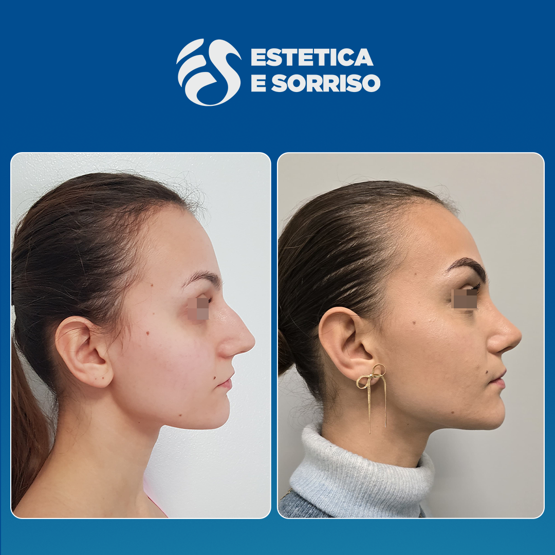 Rinoplastica in Albania - Estetica e Sorriso - Estetica e Sorriso Rinoplastica in Albania - Estetica e Sorriso