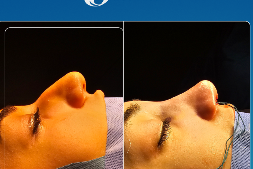 Rinoplastica in Albania - Estetica e Sorriso - Estetica e Sorriso Rinoplastica in Albania - Estetica e Sorriso