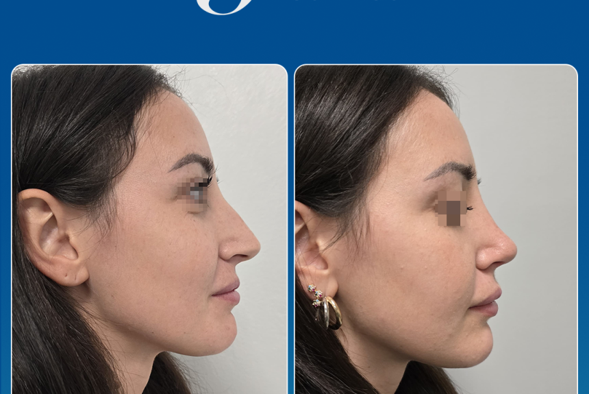 Rinoplastica in Albania - Estetica e Sorriso