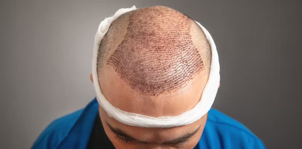 Scopri come funziona il trapianto di capelli in Albania. Tecniche moderne, risultati naturali e offerte da €2.200 presso Estetica e Sorriso.